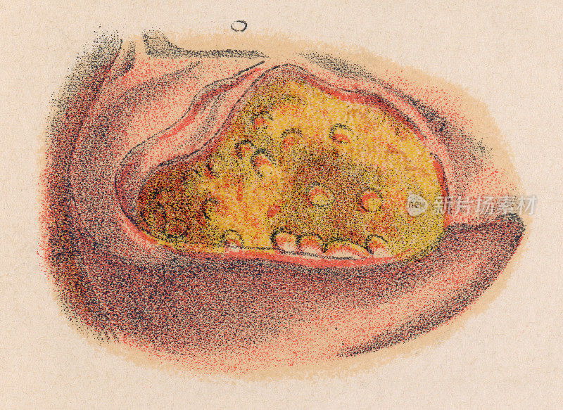 带有软下疳的人体皮肤医学插图- 19世纪